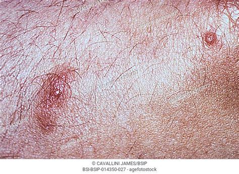 Folliculitis Is An Inflammation Of A Hair Follicle Stock Photos And