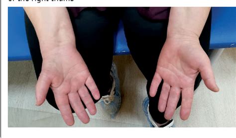 Figure 4 From Carpal And Cubital Tunnel Syndromes As The Most Common
