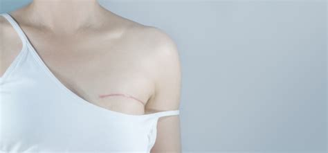 Mastectomy Surgical Types For Breast Cancer Regional Cancer Care Associates