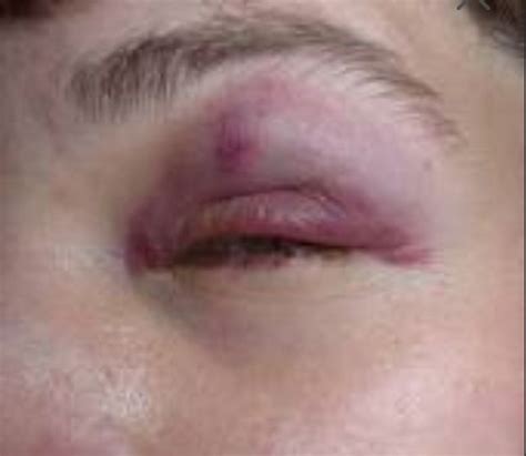 Black Eye Makeup Sfx Cuts Scratches Boils Spots Bruises