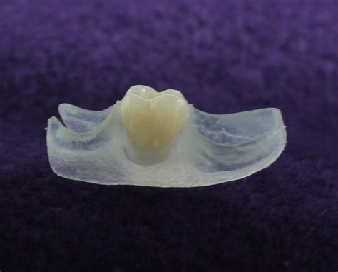 Flexible Partial Denture Moskey Dental Laboratories