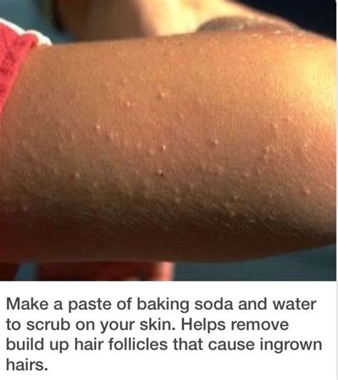 Get Rid Of Those Bumps On Your Arms And Legs Ingrown Hair Skin Care