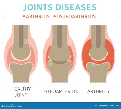 Joints Diseases Arthritis Osteoarthritis Symptoms Treatment I Stock