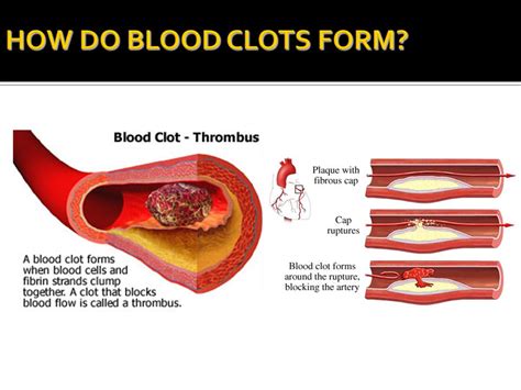 Blood Clots During Early Pregnancy Bleeding Vaginal Bleeding And Blood