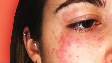 Allergic Reaction To Makeup Around Eyes Bios Pics