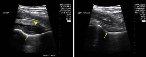 Point Of Care Ultrasound For The Detection Of Hip Effusion And Septic