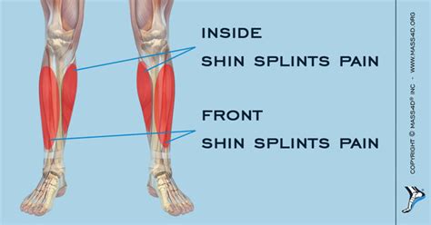 Causes And Symptoms Of Shin Splints Mass4d Insoles Mass4d Foot