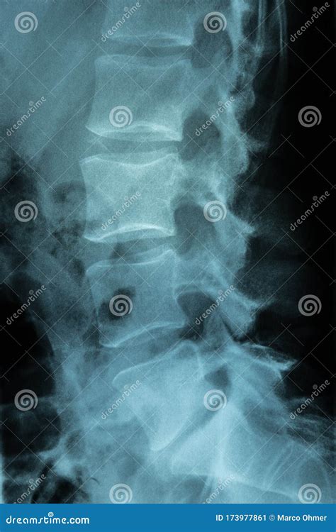 Medical Xray Scan Of A Spine Stock Image Image Of Anatomical