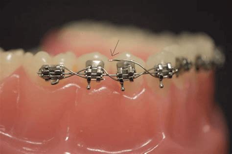 What To Do If Your Braces Are Broken Central Coast Orthodontics