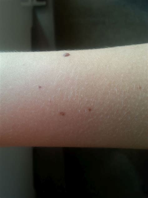How Many Moles Do You Have On Your Right Arm Why Their Number Is