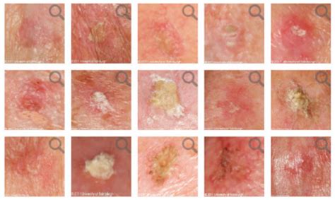 Skin cancer can be found anywhere on your body but is most commonly located on the head, neck the key to spotting skin cancer early is by paying attention to your skin. Leeds Beckett Staff And Students Develop Innovative ...