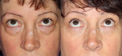 Lower Eyelid Lift Cheaper Than Retail Price Buy Clothing Accessories And Lifestyle Products