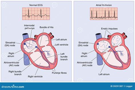 Condução Elétrica Do Coração Normal E Fibrilação Atrial Ilustração Do