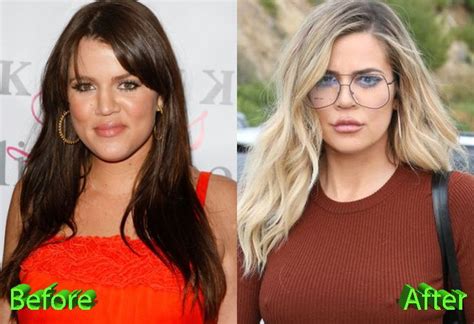Born june 27, 1984) is an american media personality, socialite, and model. Khloe Kardashian before and After Cosmetic Surgery ...