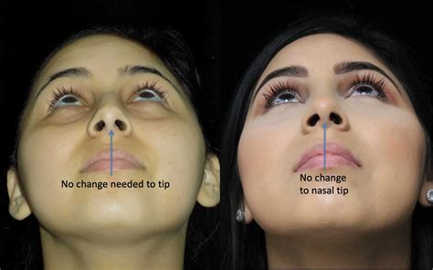 Nose Job For Wide Nose Before And After