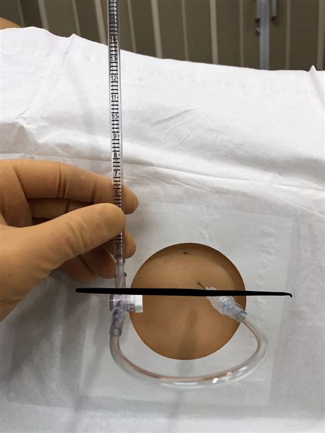 Lumbar Puncture — Taming The Sru