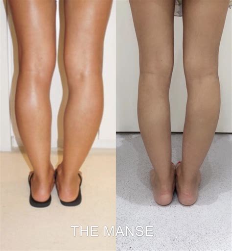 Calf Slimming Injections Best Treatment To Slim Calves The Manse