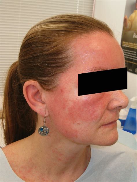 Allergic Contact Dermatitis From Formaldehyde Textile Resins In