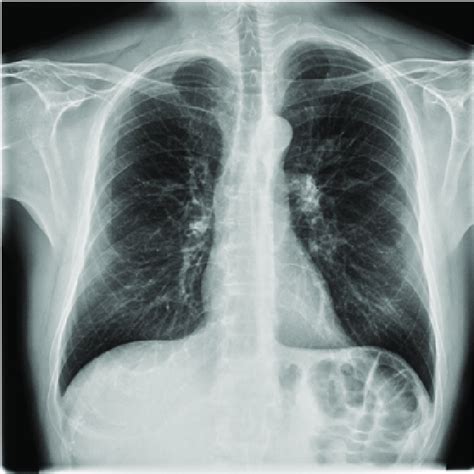Chest X Rays After 4 Months Of Therapy Shows That The Lung Nodules Have