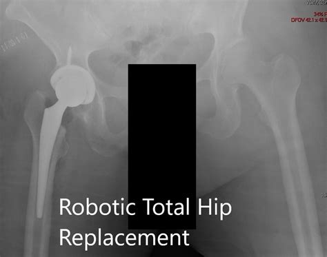 Robotic Left Hip Replacement In 71 Yr Old Female Complete Orthopedics