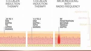 Microneedling Treatments Compared Hayes Valley Medical Esthetics