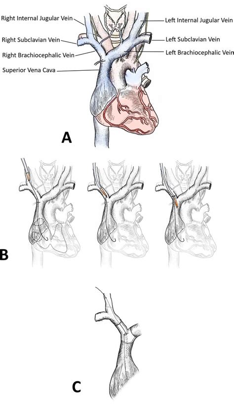 Superior Vena Cava Injury During Central Venous Catheter Insertion In A