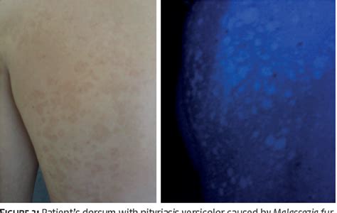 Figure From Woods Lamp In Dermatology Applications In The Daily