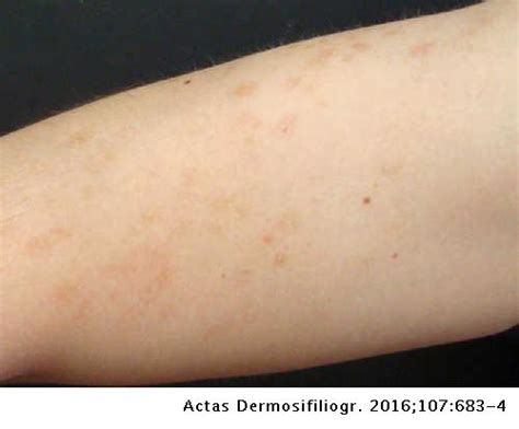 Hyperpigmented Macules On A Young Mans Arms Actas Dermo