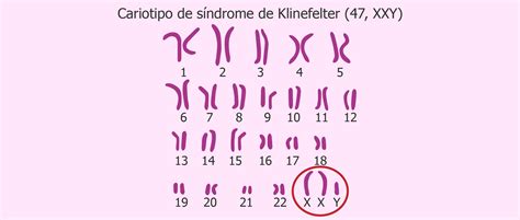 Síndrome De Klinefelter 47 Xxy Causas Características Y Síntomas