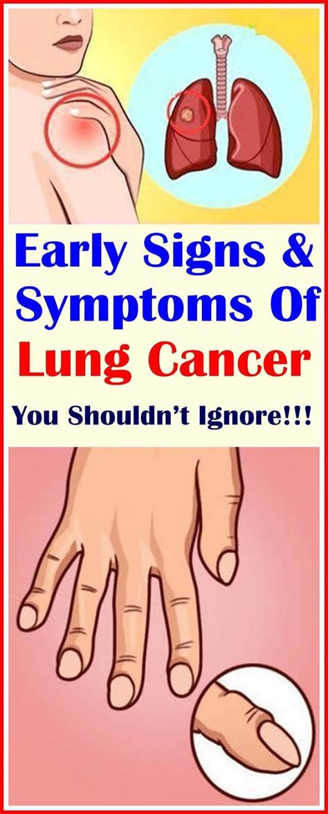 6 Early Signs Of Lung Cancer That You Shouldn T Ignore Wellness Look