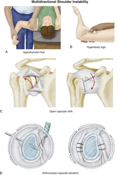 Multidirectional Shoulder Instability Musculoskeletal Key