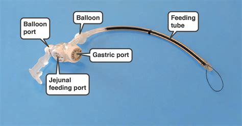 Gastrostomy Tube To Gastrojejunostomy Conversion Gillette Children