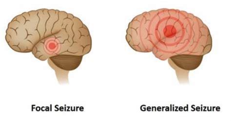 Generalized Onset Seizures Epilepsy Foundation Texas