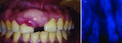 A Preoperative Clinical Presentation Labial View Showing Gingival