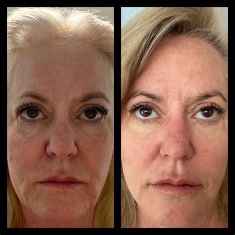 Taft Aesthetics Llc Medical Spa Wilson Nc Before After