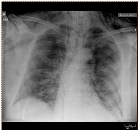 Фомина д.с., потешкина н.г., белоглазова и.п. Spontaneous Pneumothorax in COVID-19 Patients Treated with ...
