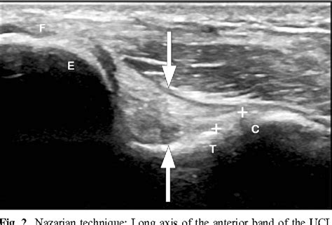 Ultrasound Evaluation Of The Ulnar Collateral Ligament Of The Elbow