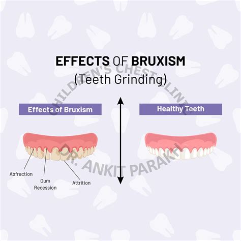 Teeth Grinding Or Bruxism In Children Dr Ankit Parakh