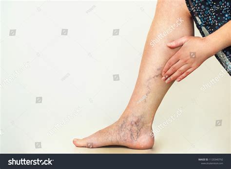 Varicose Veins On The Womans Legs Royalty Free Stock Photo 1120340792