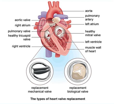 Types Of Cardiothoracic Surgery Bapshort