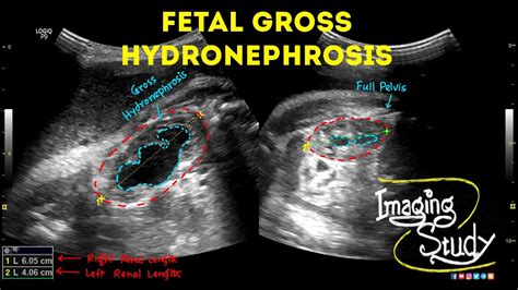 Fetal Unilateral Hydronephrosis Ultrasound Anomaly Case 44 Youtube