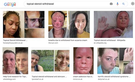 Side Effects Of Topical Steroids Tsw Assist