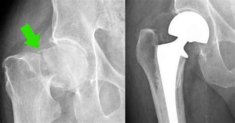 Left Femoral Neck Osteoporosis