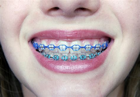 The Most Common Types Of Braces Canyon Vista Dental