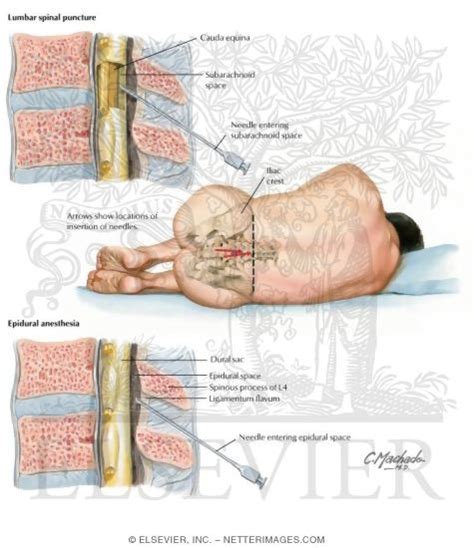 Lumbar Puncture And Epidural Anesthesia