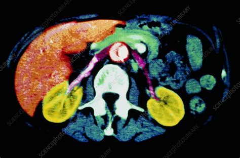 Coloured Ct Scan Of Healthy Kidneys In Abdomen Stock Image P550
