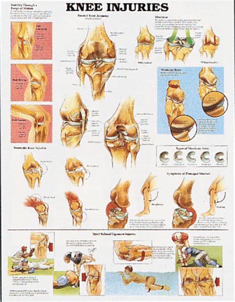 Pain at the back of the knee is known as posterior knee pain. Knee Injuries Chart