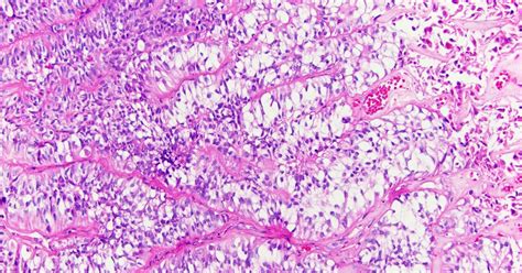 Neuropathology Blog Astroblastoma