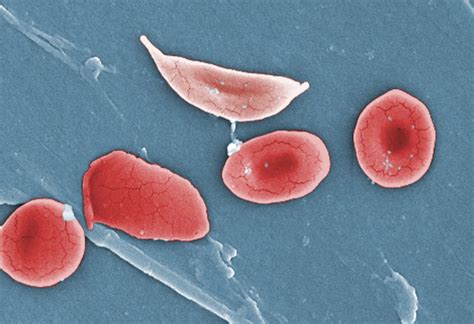 Sickle Cell Anemia Under Microscope
