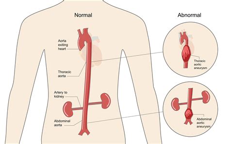 Aortic Aneurysm LaytinPride